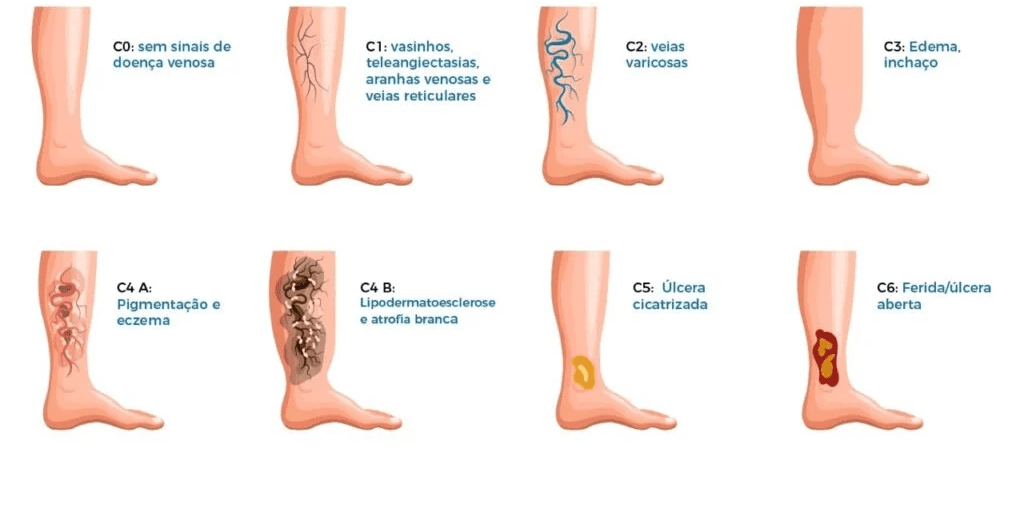 Insuficiência Venosa Crônica