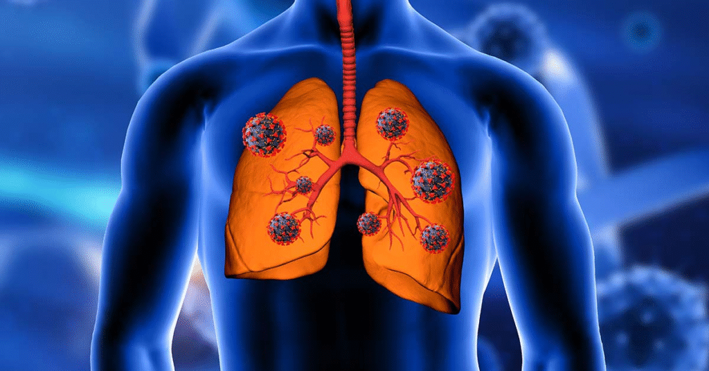 Infecção Respiratória